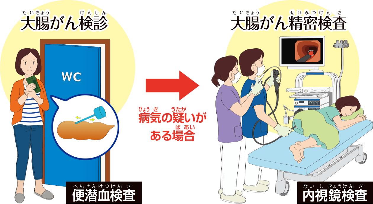 内視鏡はがんの早期発見と早期治療を助ける