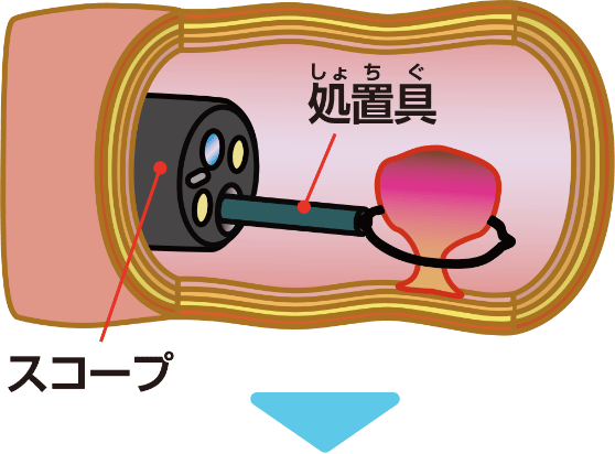 内視鏡による早期がん治療の例