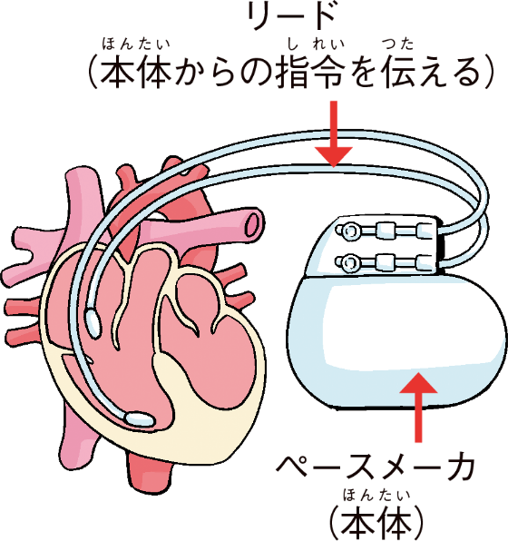 ペースメーカ